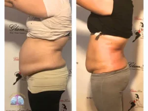 Before and after ultra cavitation body contouring results showing visible waistline reduction after 4 sessions in 2 weeks