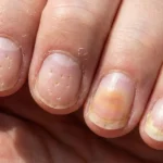 Nail Psoriasis - An inflammatory condition that causes pitting, discoloration, thickening, and crumbling of the nails